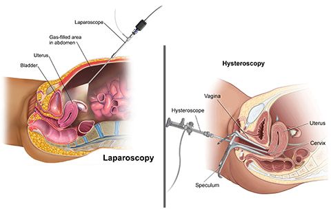 Laparoscopy Hysteroscopy